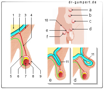 Schematische Darstellung eines Leistenbruchs