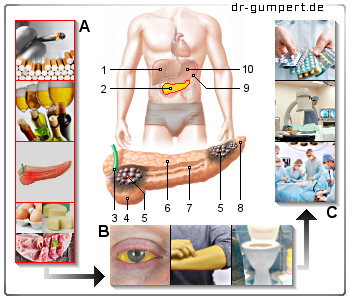 Schematische Darstellung von Bauchspeicheldrüsenkrebs