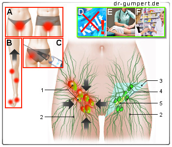 Schematische Darstellung einer Lymphknotenschwellung in der Leiste