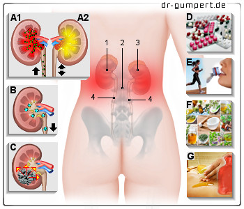 Schematische Darstellung Nierenschmerzen