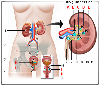 Schematische Darstellung Nierensteine