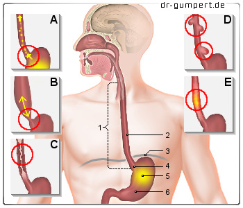 Schematische Darstellung Schmerzen an der Speiseröhre