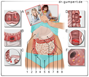 Schematische Darstellung zu Schmerzen im Dickdarm