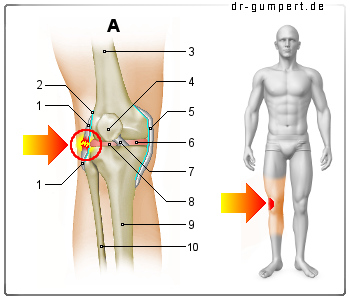 Schematische Darstellung Außenbandriss am Knie