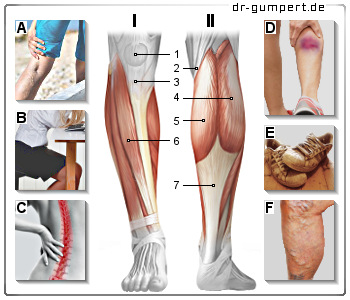 Abbildung Schmerzen am Unterschenkel