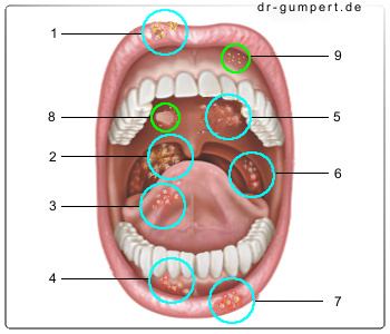 Schematische Abbildung von Aphten im Mundraum