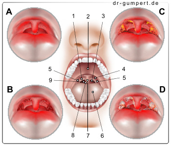 Schematische Darstellung einer Mandelentzündung