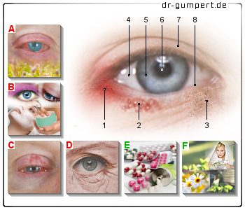 Schematische Darstellung eines Ekzems am Auge