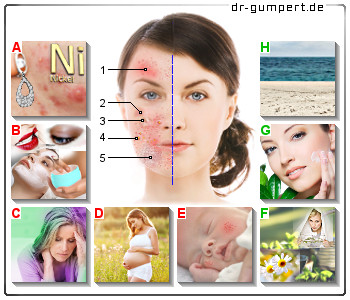 Schematische Darstellung eines Ekzems im Gesicht