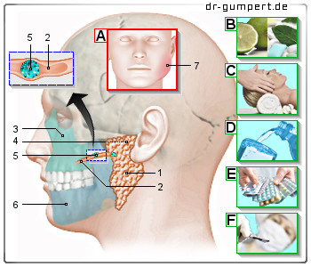 Schematische Darstellung einer Ohrspeicheldrüsenentzündnung