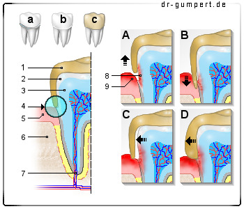 Schematische Darstellung einer Zahnkronenentzündung