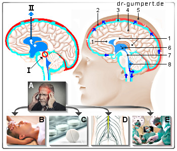Schematische Darstellung eines erhöhten Hirndrucks
