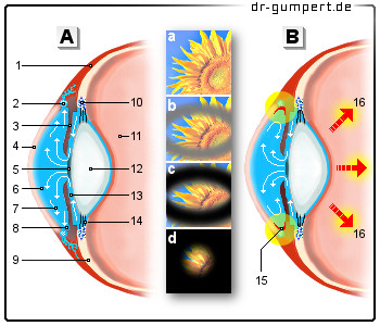 Schematische Darstellung des Glaukoms (grüner Star)