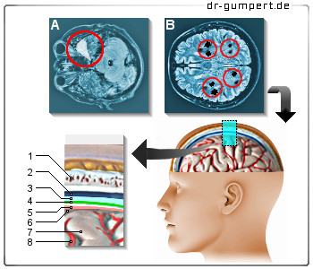 Schematische Darstellung von Hirnzysten