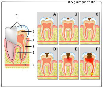 Schematische Darstellung der Symptome von Karies