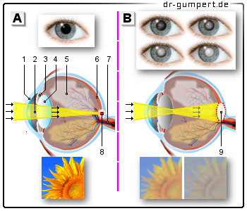 Schematische Darstellung des Katarakts (grauer Star)