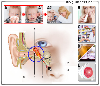 Schematische Darstellung einer Mittelohrentzündung