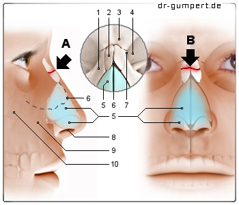 Schematische Darstellung eines Nasenbeinbruchs