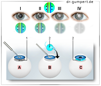 Schematische Darstellung einer Operation des Katarakts