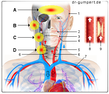 Schematische Darstellung zu Schmerzen an der Halsschlagader