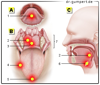 Schematische Darstellung der Schmerzen an der Zunge