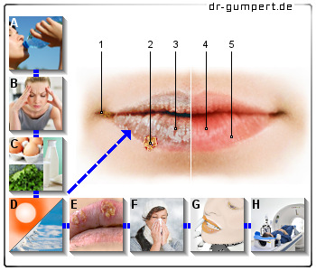 Schematische Darstellung Trockene Lippen