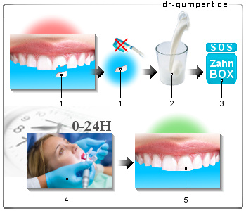Schematische Darstellung eines abgebrochenen Zahns
