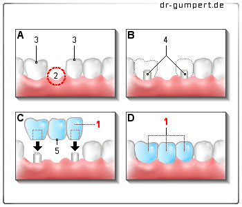 Schematische Darstellung einer Zahnbrücke