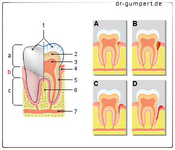 Schematische Darstellung von Zahnhalsschmerzen
