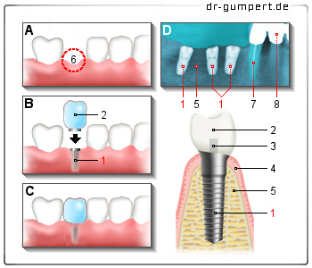 Schematische Darstellung eines Zahnimplantats