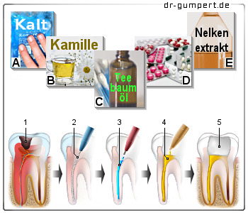 Schematische Darstellung von Zahnschmerzen nach einer Füllung