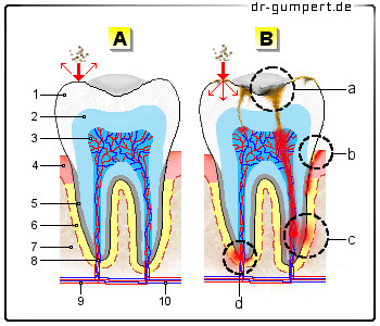 Schematische Darstellung der Zahnwurzelentzündung