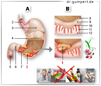 Schematische Darstellung eines Magengeschwürs