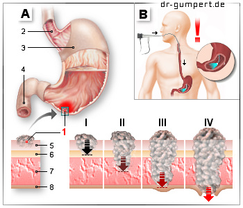 Schematishe Darstellung des Magenkrebs