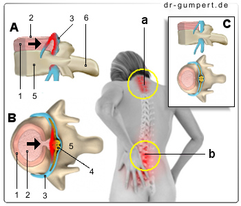 Schematische Darstellung eines Bandscheibenvorfalls