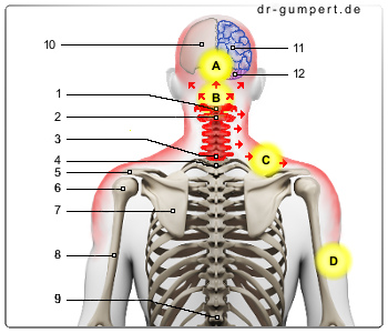 Schematische Darstellung eines HWS-Syndroms