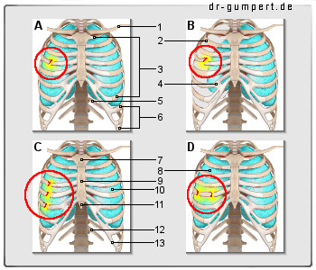 Schematische Darstellung eines Rippenbruchs