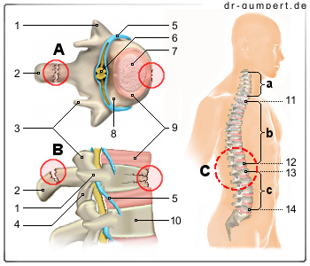 Schematische Darstellung eines Wirbelbruchs