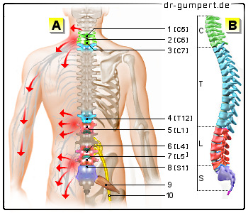 Schematische Darstellung des Bandscheibenvorfall - Symptome