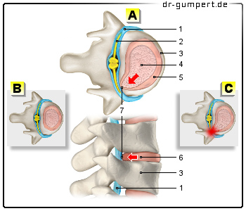 Schematische Darstellung der Bandscheibenvorwölbung