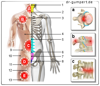 Abbildung Rückenschmerzen