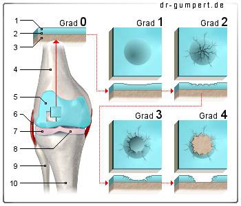 Schematische Darstellung eines Knorpelschadens