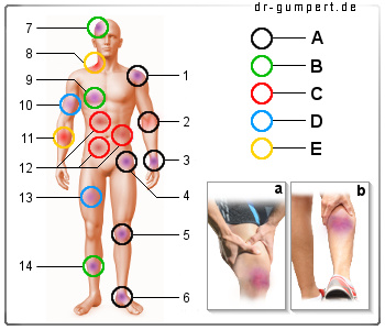 Schematische Darstellung einer Prellung