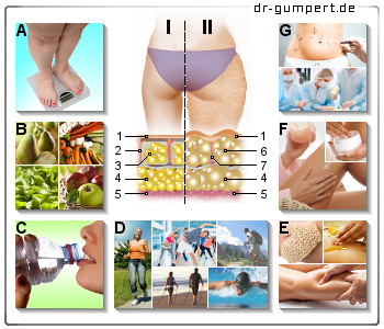 Schematische Darstellung der Möglichkeiten zur Stärkung des Bindegewebes