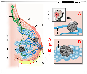 Schematische Darstellung eines Brustkrebs