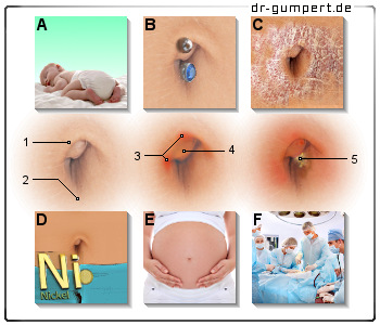 Schematische Darstellung einer Bauchnabelentzündung