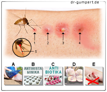 Schematische Darstellung einer Entzündung nach Insektenstich
