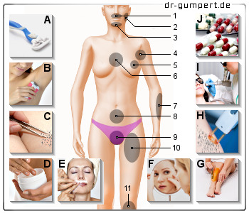 Schematische Darstellung des Haarwuchses bei Frauen