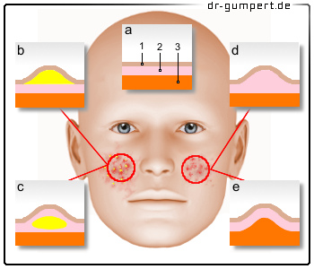 Schematische Darstellung des  Hautausschlagsd im  Gesicht
