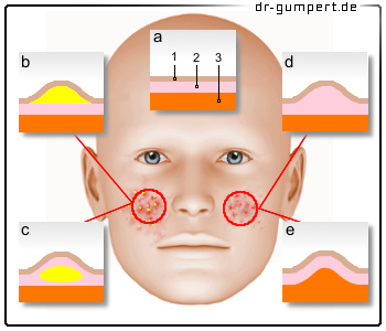 Hautausschlag Im Gesicht Was Ist Die Ursache